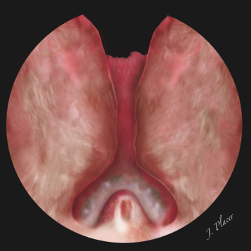 Figura 4. Incisión transversa practicada de forma proximal al verumontanum