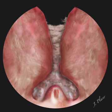 Figura 5. Incisión practicada desde el cuello de la vejiga hasta el verumontanum. La incisión se realiza a nivel de las 5, 6 o 7 horarias en función de la anatomía de la glándula (próstata bilobulada o trilobulada) y se extiende hacia ambos lóbulos laterales para crear un amplio canal
