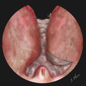 Figura 6. Disección del lóbulo apical izquierdo